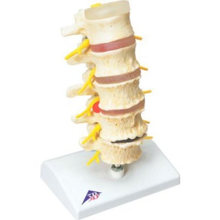 FABRICATION ENTERPRISES 3B® Anatomical Model - Vertebrae Degeneration, Stages of Prolapsed Disc 12-4542